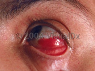 Clinical image of Subconjunctival hemorrhage