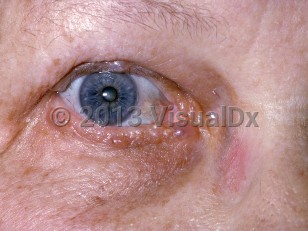 Clinical image of Apocrine hidrocystoma - imageId=194172. Click to open in gallery.  caption: 'Numerous small, translucent cystic papules on the upper and lower eyelid margins.'