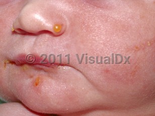 Clinical image of Dystrophic epidermolysis bullosa - imageId=198108. Click to open in gallery.  caption: 'Vesicles on the nose and scattered crusts on the lower face.'