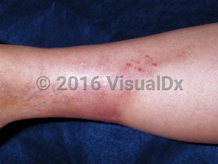 Clinical image of Lipodermatosclerosis - imageId=199728. Click to open in gallery.  caption: 'A depressed light brown and violaceous plaque of the lower leg, imparting a champagne-bottle-like appearance to the leg.'