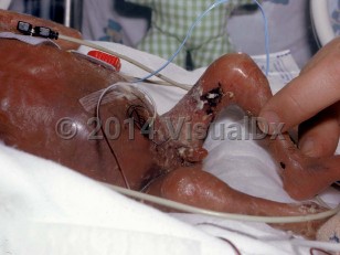 Clinical image of Primary cutaneous aspergillosis of premature infants - imageId=2015388. Click to open in gallery.  caption: 'A crusted nodule on the abdomen and eschars on the leg.'