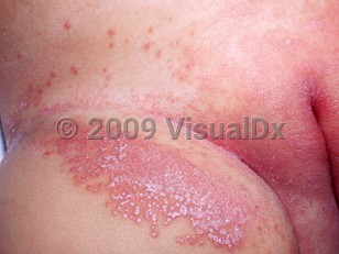 Clinical image of Diaper dermatitis candidiasis - imageId=2026908. Click to open in gallery. 