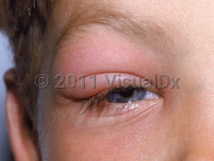 Clinical image of Honeybee sting - imageId=2030222. Click to open in gallery.  caption: 'Marked edema and erythema of the upper eyelid.'