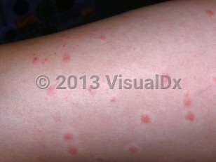 Clinical image of Cercarial dermatitis - imageId=2032752. Click to open in gallery.  caption: 'Erythematous and edematous papules, many with a blanched halo, and some tiny crusts on the leg.'