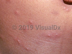 Clinical image of Flea bite - imageId=2033960. Click to open in gallery.  caption: 'A close-up of numerous tiny erythematous and edematous papules, some with central puncta.'