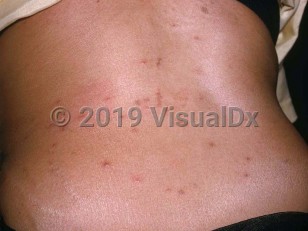 Clinical image of Mite dermatitis - imageId=2035118. Click to open in gallery.  caption: 'Numerous reddish and brown papules, some in linear arrays, on the back.'