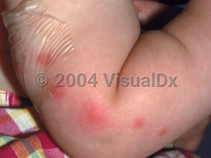Clinical image of Papular urticaria - imageId=2040355. Click to open in gallery.  caption: 'Edematous, erythematous papules and plaques on the arm.'
