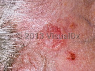 Clinical image of Nodular basal cell carcinoma - imageId=204149. Click to open in gallery.  caption: 'A reddish plaque with telangiectasias and a raised, shiny, rolled border at the anterior hairline.'
