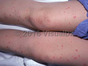 Clinical image of Trichosporon sepsis - imageId=2042393. Click to open in gallery. 