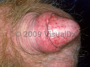 Clinical image of Balanoposthitis - imageId=2045951. Click to open in gallery. 
