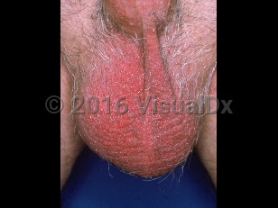 Clinical image of Red scrotum syndrome - imageId=2046108. Click to open in gallery.  caption: 'Diffuse bright red erythema of the scrotum.'