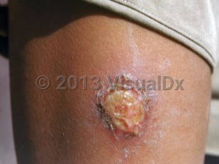 Clinical image of Yaws