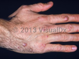 Clinical image of Sea urchin sting