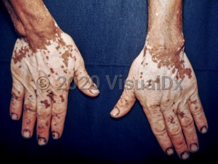 Clinical image of Pinta - imageId=2057099. Click to open in gallery.  caption: 'Depigmented macules and patches on the dorsal hands and fingers.'