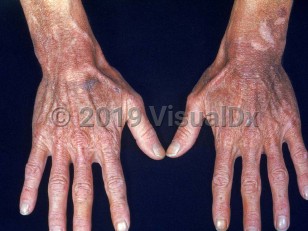 Clinical image of Pellagra - imageId=2057827. Click to open in gallery. 