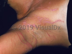 Clinical image of Portuguese man-of-war sting