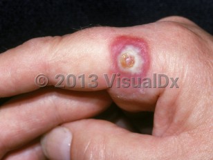 Clinical image of Orf - imageId=2084864. Click to open in gallery.  caption: 'A deeply erythematous nodule with an overlying large pustule and a central crust ("target" stage) on the finger.'