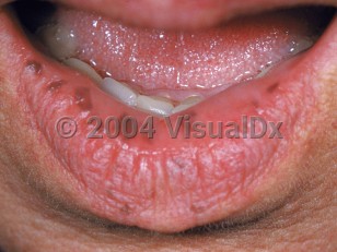 Clinical image of Peutz-Jeghers syndrome - imageId=2092799. Click to open in gallery.  caption: 'Numerous brown and grayish macules on the vermillion and the lower labial mucosa.'