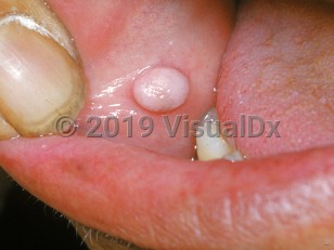 Clinical image of Oral fibroma - imageId=2098244. Click to open in gallery.  caption: 'A whitish nodule on the buccal mucosa.'