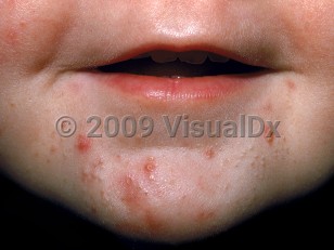 Clinical image of Infantile acne - imageId=2102454. Click to open in gallery.  caption: 'Erythematous acneiform papules and open comedones on the chin of an infant.'