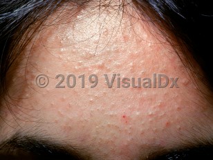Clinical image of Acne vulgaris