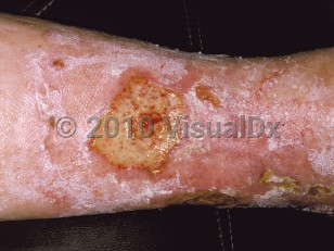 Clinical image of Stasis ulcer - imageId=210935. Click to open in gallery.  caption: 'Numerous ulcers of varying sizes with yellow slough at their bases and surrounding erythema on the leg.'