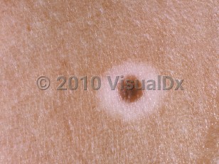 Clinical image of Halo nevus - imageId=211205. Click to open in gallery.  caption: 'A close-up of a brown papule with a surrounding depigmented halo.'