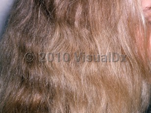 Clinical image of Acquired progressive kinking of hair - imageId=2112732. Click to open in gallery.  caption: 'Wavy, unruly hair.'
