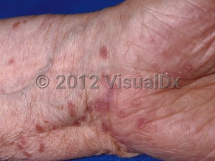 Clinical image of Lichen planus - imageId=21134. Click to open in gallery.  caption: 'Flat-topped violaceous polygonal papules, some annular, with fine white scale at the wrist.'