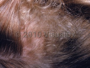 Clinical image of Woolly hair nevus - imageId=2113471. Click to open in gallery.  caption: 'A focal area of curly, lighter, unruly hair on the scalp.'