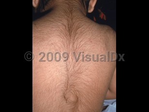 Clinical image of Hypertrichosis - imageId=2123187. Click to open in gallery.  caption: 'Global terminal hair growth on the back.'