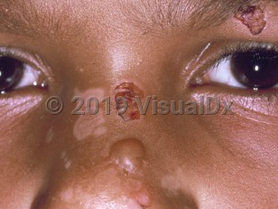 Clinical image of Bullous pemphigoid of childhood - imageId=2135869. Click to open in gallery.  caption: 'A bulla and some crusting and hypopigmented macules on the central face.'