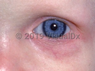 Clinical image of Hypohidrotic ectodermal dysplasia - imageId=2138192. Click to open in gallery.  caption: 'Absent eyebrow and very few, short eyelash hairs.'