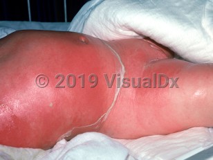 Clinical image of Staphylococcal scalded skin syndrome - imageId=2140314. Click to open in gallery.  caption: 'Diffuse bright red erythema with large areas of overlying peeling on the trunk and legs.'