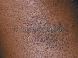 Clinical image of Atopic dermatitis - imageId=214627. Click to open in gallery.  caption: 'A close-up of follicular papules with scale.'