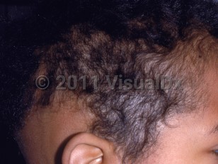 Clinical image of Radiation-induced alopecia