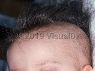 Clinical image of Thallium poisoning - imageId=2152291. Click to open in gallery.  caption: 'Patchy hair loss on the scalp and thinned eyebrows.'