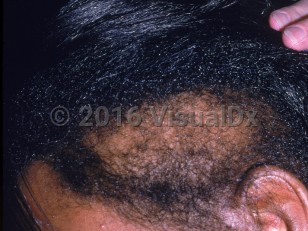 Clinical image of Congenital triangular alopecia - imageId=2152423. Click to open in gallery.  caption: 'A patch of alopecia at the temporal scalp.'