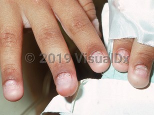 Clinical image of Hypoparathyroidism - imageId=2155670. Click to open in gallery.  caption: 'Micronychia and pterygium formation of the fingernails.'