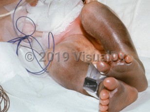 Clinical image of Breech baby injury - imageId=2163890. Click to open in gallery.  caption: '<span>Bruised legs resulting from double footing breech in premature infant.</span>'