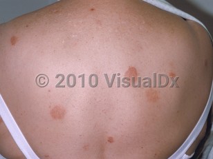 Clinical image of Nummular dermatitis