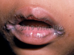 Clinical image of Angular cheilitis - imageId=2172451. Click to open in gallery.  caption: 'Fissured pinkish and brown papules at the oral commissures.'