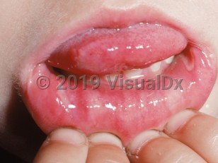 Clinical image of Aphthous stomatitis - imageId=2173448. Click to open in gallery.  caption: 'Two large, deep ulcers with overlying yellowish slough on the lower labial mucosa.'