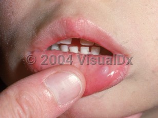 Clinical image of Oral mucocele