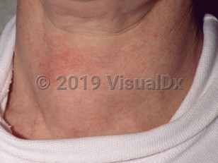 Clinical image of Hypothyroidism - imageId=218268. Click to open in gallery.  caption: 'Goiter in hypothyroidism.'