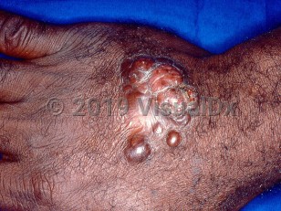 Clinical image of Lobomycosis