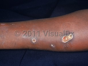 Clinical image of Skin popping substance abuse - imageId=2193412. Click to open in gallery.  caption: 'Crusted papules and ulcers on the arm.'