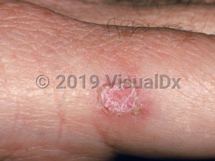 Clinical image of Iododerma - imageId=2199226. Click to open in gallery.  caption: 'A scaly and crusted pink papule on the finger, developing after administration of iodides.'