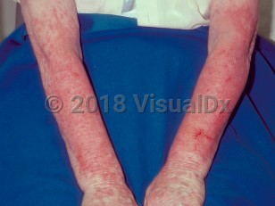 Clinical image of Drug-induced photosensitive reaction - imageId=220003. Click to open in gallery.  caption: 'Scaly and crusted erythematous plaques on the photoexposed aspects of the forearms and hands.'