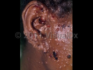 Clinical image of African histoplasmosis - imageId=2200034. Click to open in gallery.  caption: 'Multiple pink papules of varying sizes, some crusted, on the ear, cheek, and neck.'